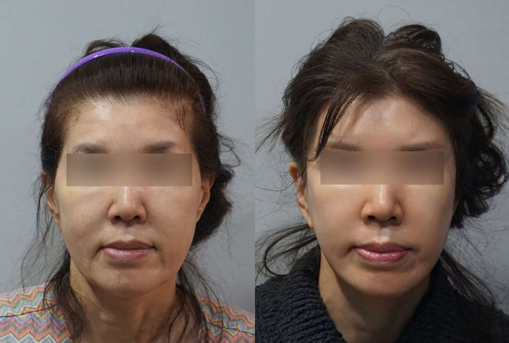 안면거상술