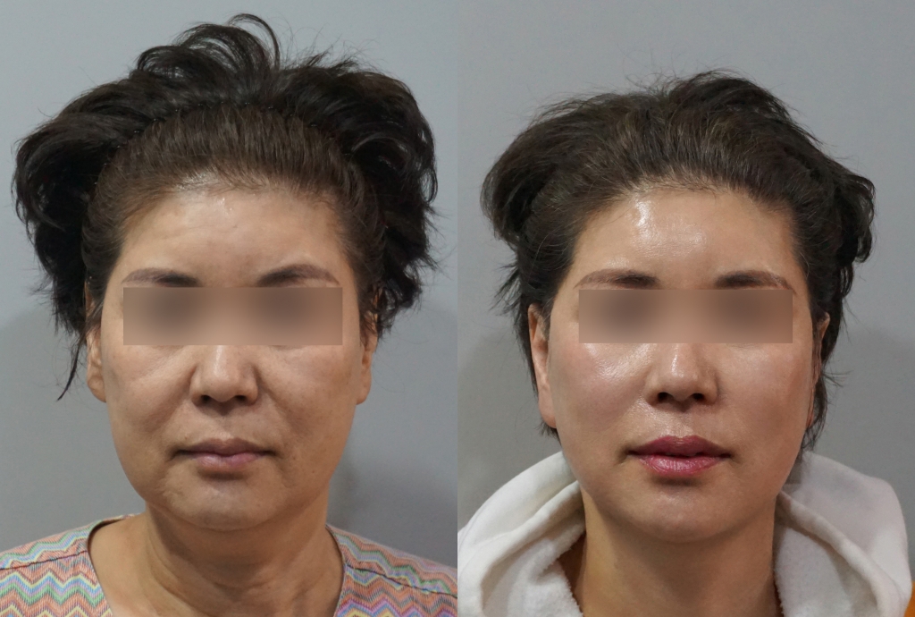 안면거상술
